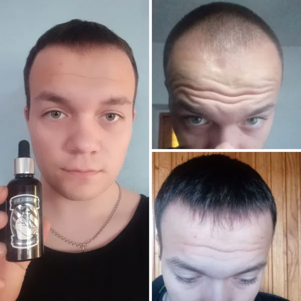 Лосьйон для росту волосся та бороди minoxidil:15% (50 мл)