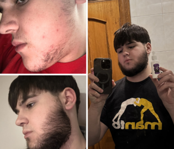 Лосьйон для росту волосся та бороди minoxidil10%(200 мл)