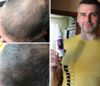 Лосьйон для росту волосся та бороди minoxidil10%(200 мл)