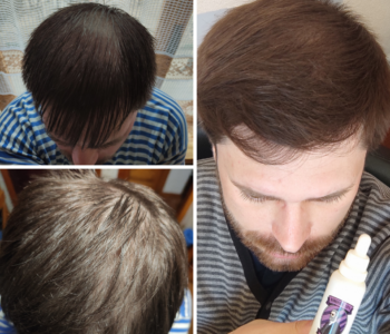 Лосьйон для росту волосся та бороди minoxidil10%(200 мл)