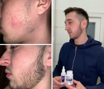 Лосьйон для росту волосся та бороди minoxidil10%(200 мл)