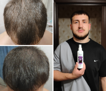 Лосьйон для росту волосся та бороди minoxidil10%(200 мл)