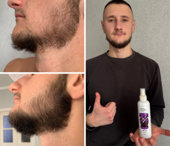 Лосьйон для росту волосся та бороди minoxidil10%(200 мл)