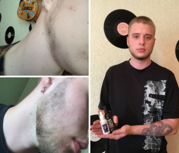 Лосьйон для росту волосся та бороди minoxidil10%(200 мл)