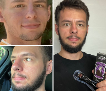 Лосьйон для росту волосся та бороди minoxidil10%(200 мл)